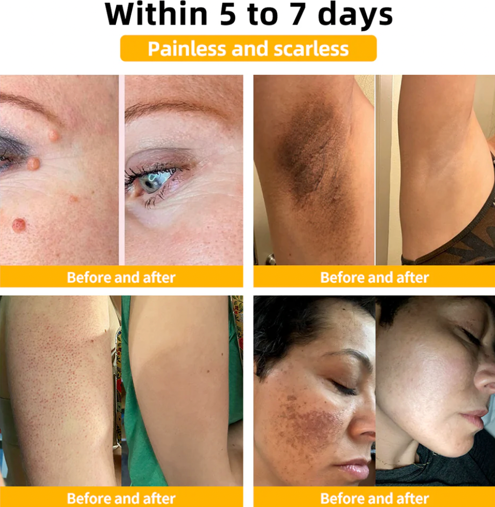 Bee Venom Skin Treatment