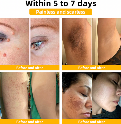 Bee Venom Skin Treatment